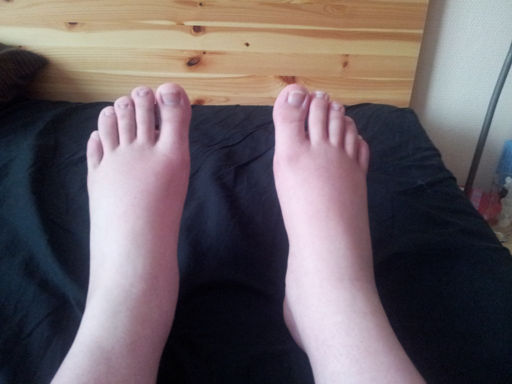 7 raisons pour lesquelles vous avez les pieds gonfl s et comment y