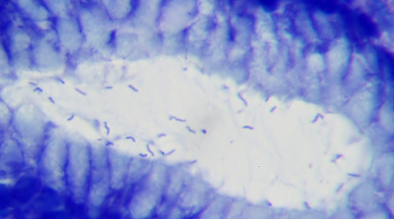 Hélicobacter Pylori