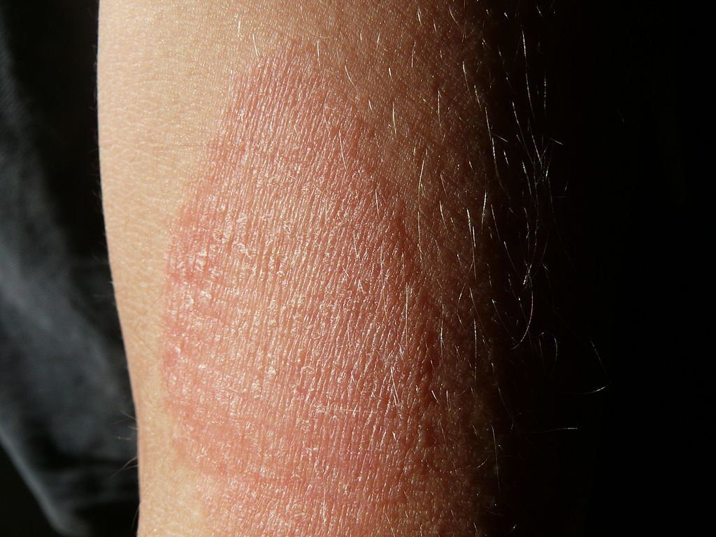Eczéma 13 traitements naturels qui fonctionnent Therapeutes Magazine