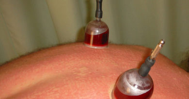 cupping