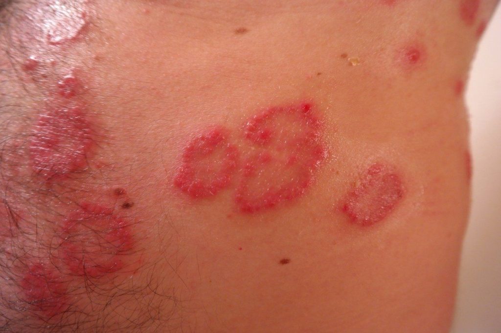 soulager psoriasis naturellement