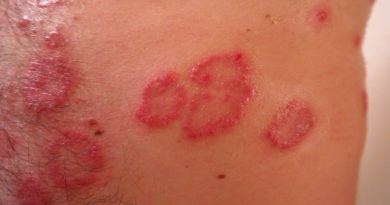 soulager psoriasis naturellement