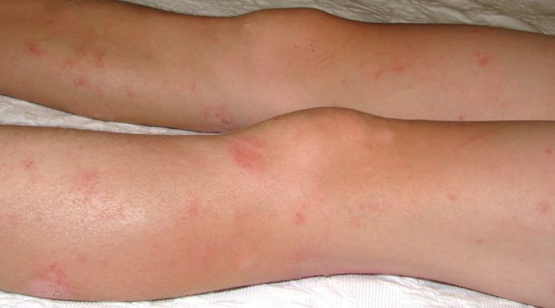 Eczema solutions naturelles